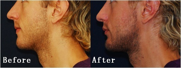 미국에서 많이하는 성형수술 세가지 | 인스티즈