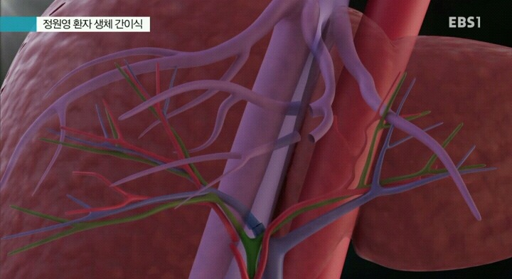 간이식수술 방법.jpg | 인스티즈