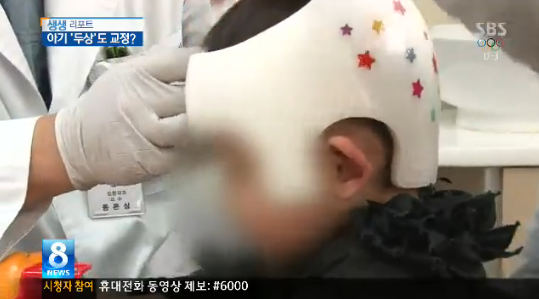 어린아이들에게 두상교정기를 씌우는 애엄마들 | 인스티즈