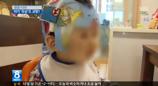 어린아이들에게 두상교정기를 씌우는 애엄마들 | 인스티즈